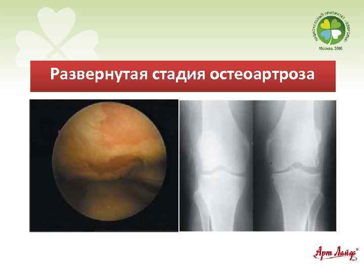 Развернутая стадия остеоартроза 