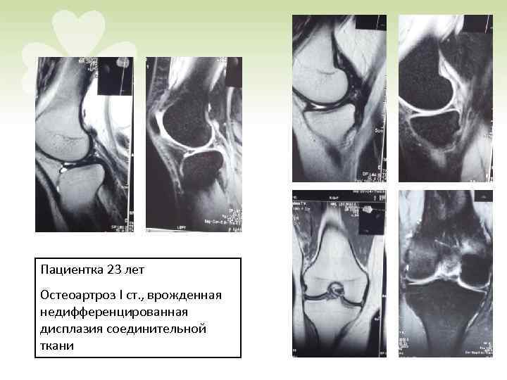 Пациентка 23 лет Остеоартроз I ст. , врожденная недифференцированная дисплазия соединительной ткани 