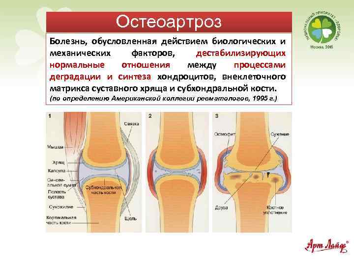 Остеоартроз Болезнь, обусловленная действием биологических и механических факторов, дестабилизирующих нормальные отношения между процессами деградации
