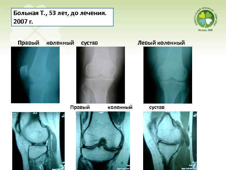 Больная Т. , 53 лет, до лечения. 2007 г. Правый коленный сустав Левый коленный