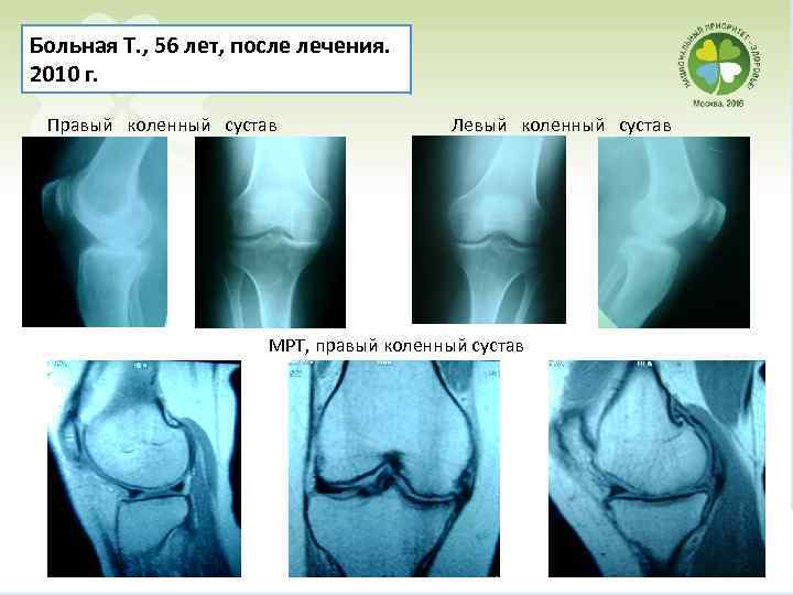 Больная Т. , 56 лет, после лечения. 2010 г. Правый коленный сустав Левый коленный