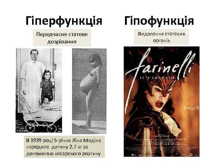 Гіперфункція Передчасне статеве дозрівання В 1939 році 5 -річна Ліна Медіна народила дитину 2.