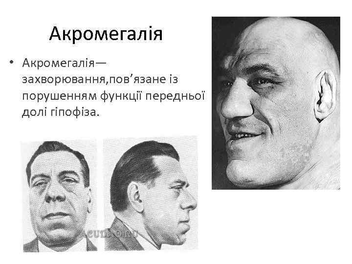 Акромегалія • Акромегалія— захворювання, пов’язане із порушенням функції передньої долі гіпофіза. 