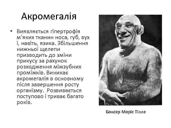 Акромегалія • Виявляється гіпертрофія м’яких тканин носа, губ, вух і, навіть, язика. Збільшення нижньої