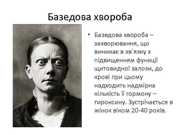 Базедова хвороба • Базедова хвороба – захворювання, що виникає в зв`язку з підвищенням функції