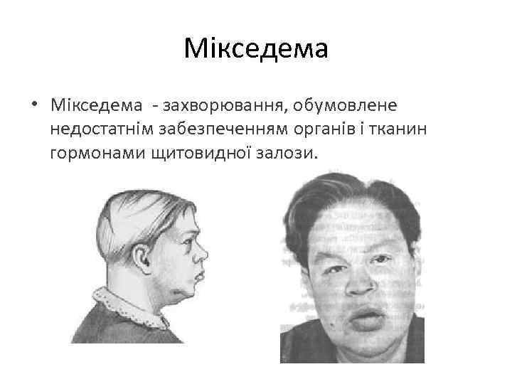 Мікседема • Мікседема - захворювання, обумовлене недостатнім забезпеченням органів і тканин гормонами щитовидної залози.