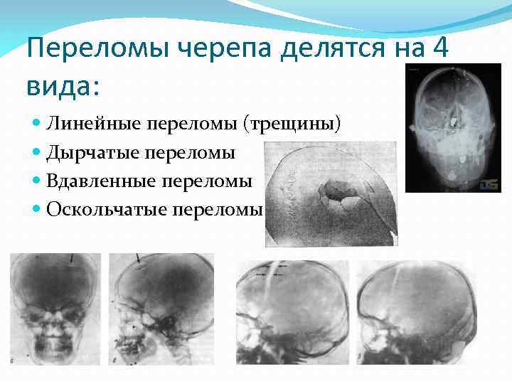 Переломы черепа делятся на 4 вида: Линейные переломы (трещины) Дырчатые переломы Вдавленные переломы Оскольчатые