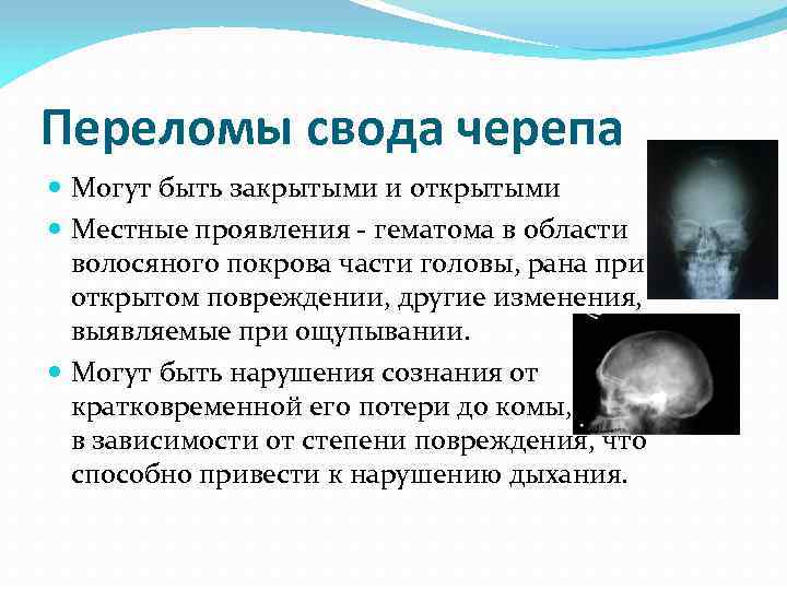 Переломы свода черепа Могут быть закрытыми и открытыми Местные проявления - гематома в области