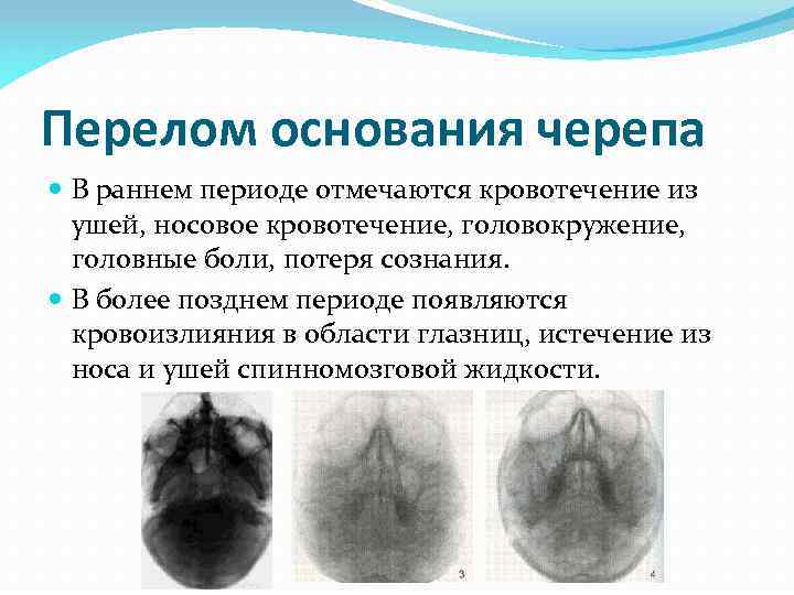 Перелом основания черепа В раннем периоде отмечаются кровотечение из ушей, носовое кровотечение, головокружение, головные