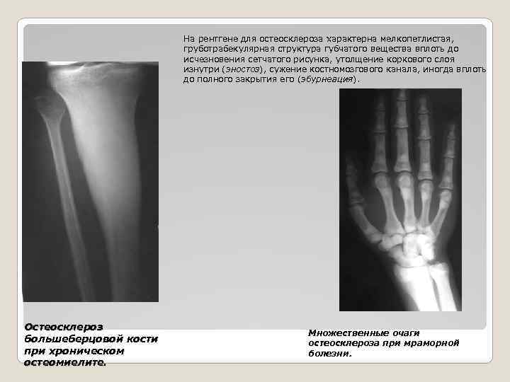 На рентгене для остеосклероза характерна мелкопетлистая, груботрабекулярная структура губчатого вещества вплоть до исчезновения сетчатого
