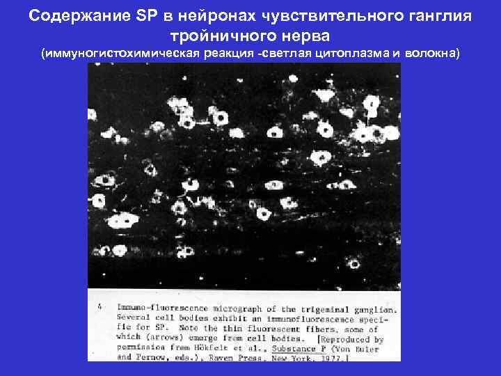 Содержание SP в нейронах чувствительного ганглия тройничного нерва (иммуногистохимическая реакция -светлая цитоплазма и волокна)