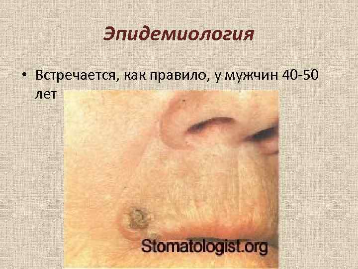 Эпидемиология • Встречается, как правило, у мужчин 40 -50 лет 