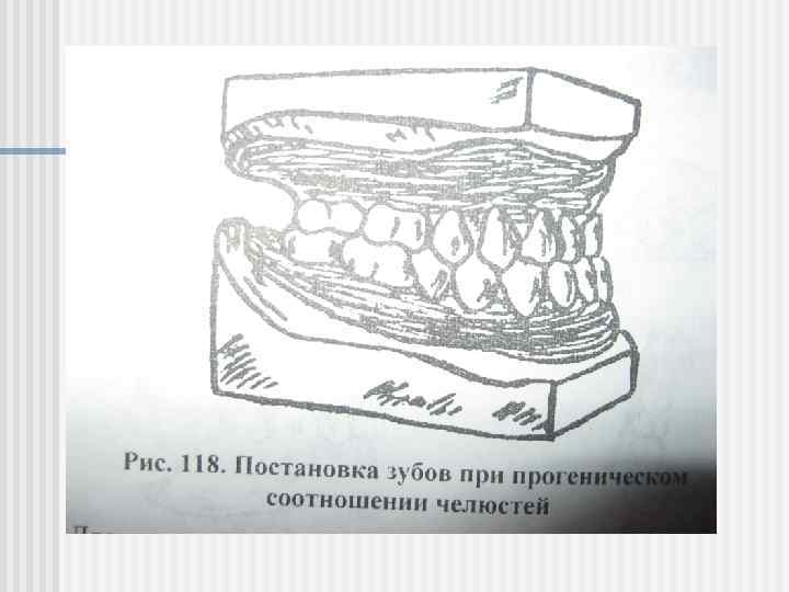 Постановка зубов по васильеву по стеклу презентация