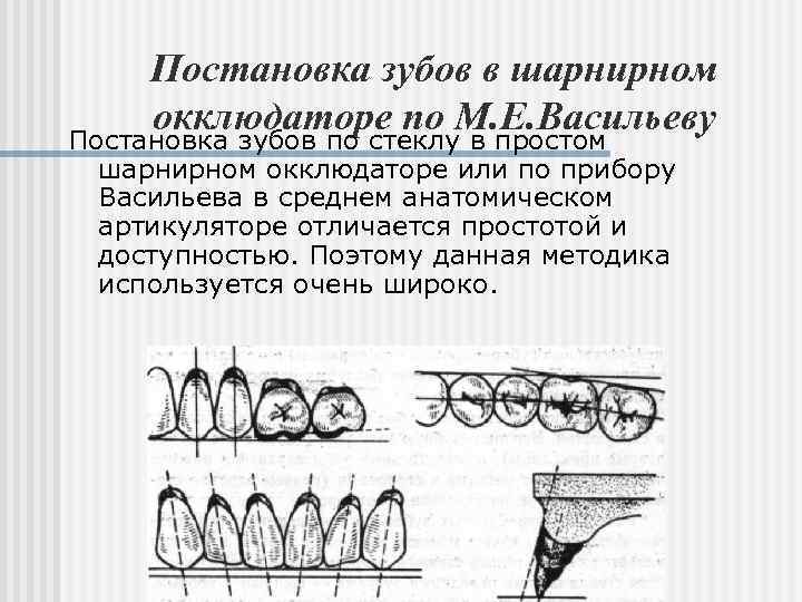 Постановка зубов по васильеву по стеклу презентация