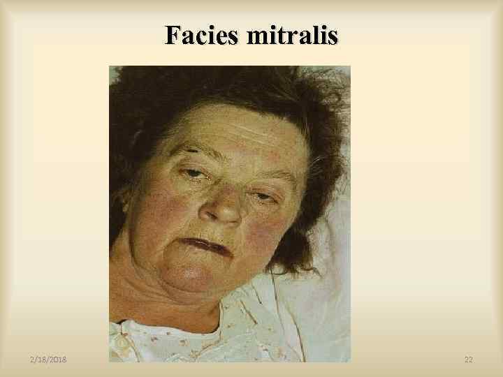 Facies mitralis 2/18/2018 22 