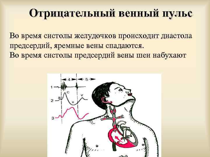 Отрицательный венный пульс Во время систолы желудочков происходит диастола предсердий, яремные вены спадаются. Во