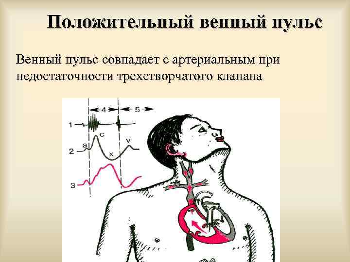 Положительный венный пульс Венный пульс совпадает с артериальным при недостаточности трехстворчатого клапана 