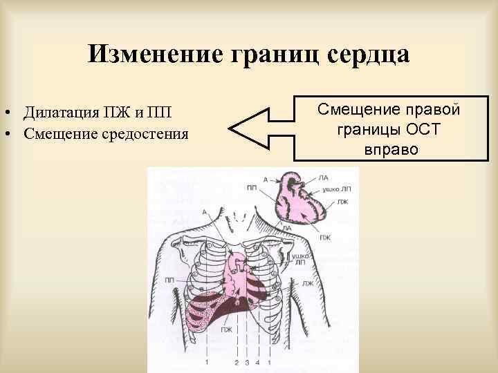 Изменение границ сердца • Дилатация ПЖ и ПП • Смещение средостения Смещение правой границы