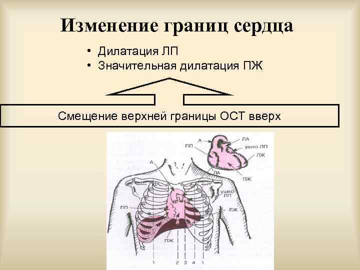 Изменение границ сердца • Дилатация ЛП • Значительная дилатация ПЖ Смещение верхней границы ОСТ