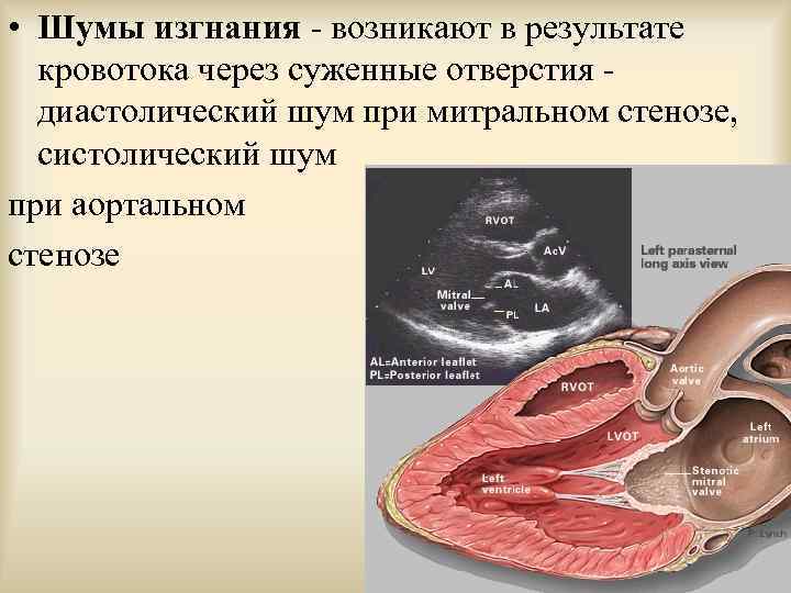  • Шумы изгнания - возникают в результате кровотока через суженные отверстия диастолический шум