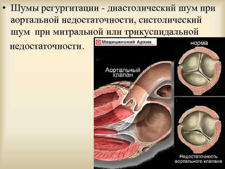  • Шумы регургитации - диастолический шум при аортальной недостаточности, систолический шум при митральной