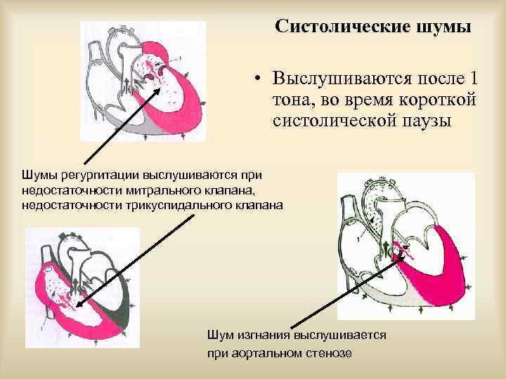 Минимальная аортальная регургитация