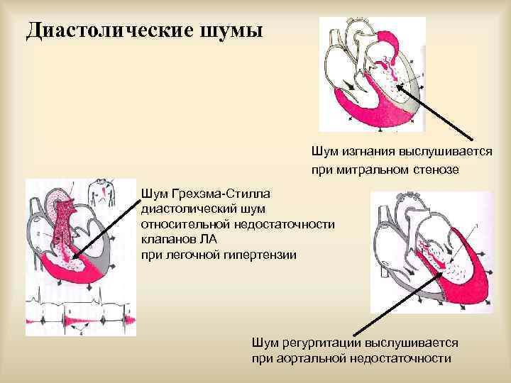 Аускультативная картина при митральном стенозе сердца включает на верхушке