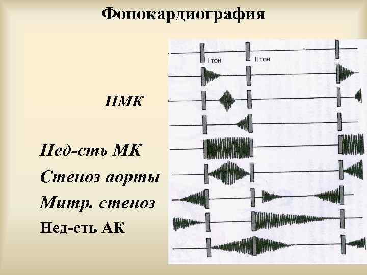 Фонокардиография ПМК Нед-сть МК Стеноз аорты Митр. стеноз Нед-сть АК 