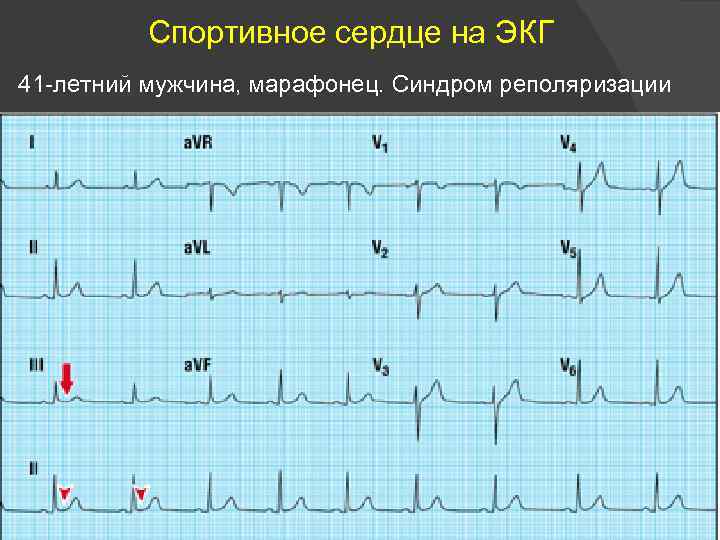 Спортивное сердце на ЭКГ 41 -летний мужчина, марафонец. Синдром реполяризации 