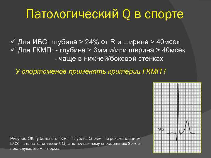 Патологический Q в спорте ü Для ИБС: глубина > 24% от R и ширина