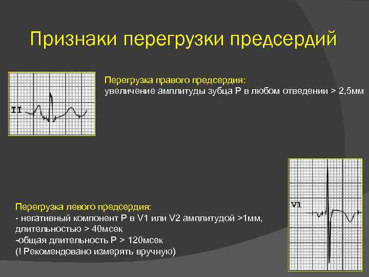 Признаки перегрузки предсердий Перегрузка правого предсердия: увеличение амплитуды зубца Р в любом отведении >