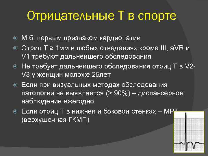 Отрицательные Т в спорте М. б. первым признаком кардиопатии Отриц Т ≥ 1 мм