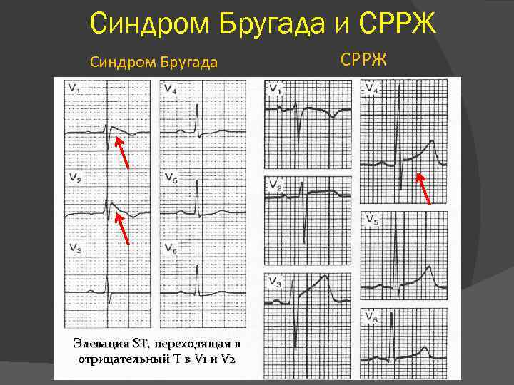 Синдром бругада презентация