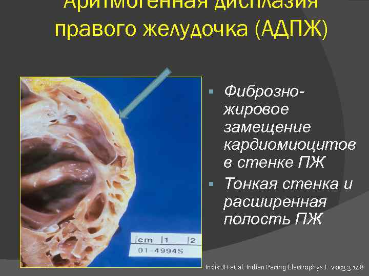 Аритмогенная дисплазия правого желудочка (АДПЖ) Фиброзножировое замещение кардиомиоцитов в стенке ПЖ Тонкая стенка и