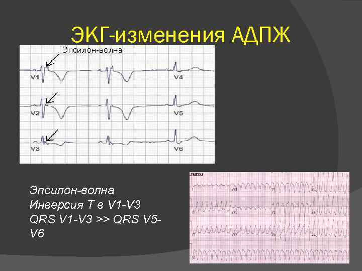 ЭКГ-изменения АДПЖ Эпсилон-волна Инверсия Т в V 1 -V 3 QRS V 1 -V