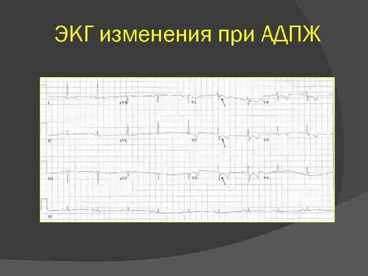 ЭКГ изменения при АДПЖ 