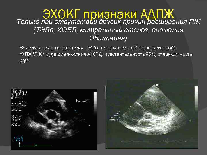 ЭХОКГ признаки АДПЖ ПЖ Только при отсутствии других причин расширения (ТЭЛа, ХОБЛ, митральный стеноз,