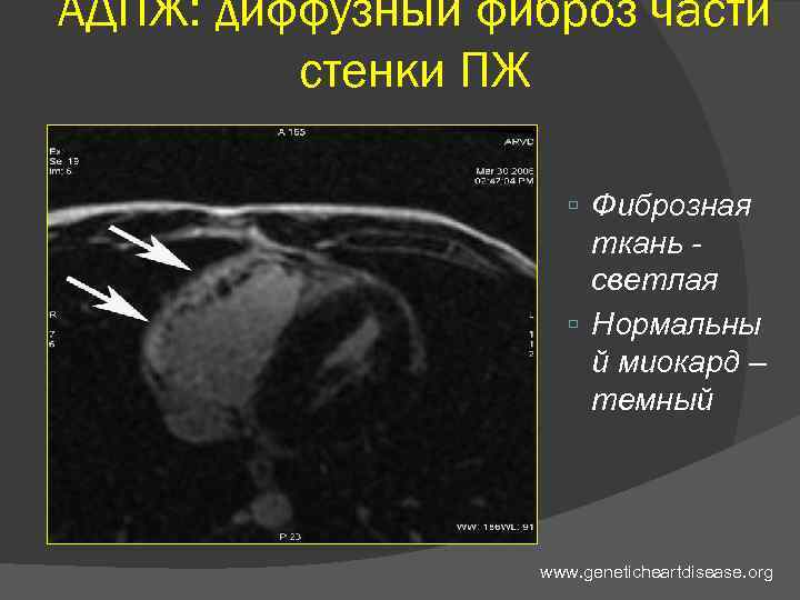 АДПЖ: диффузный фиброз части стенки ПЖ Фиброзная ткань светлая Нормальны й миокард – темный