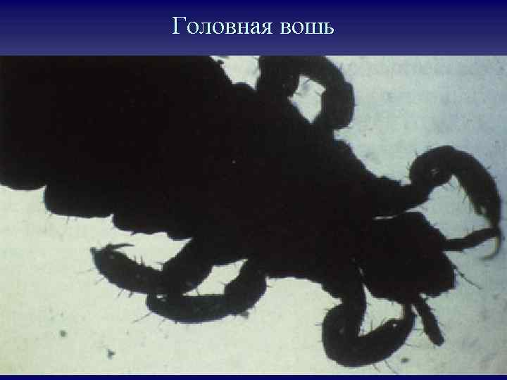 Головная вошь 