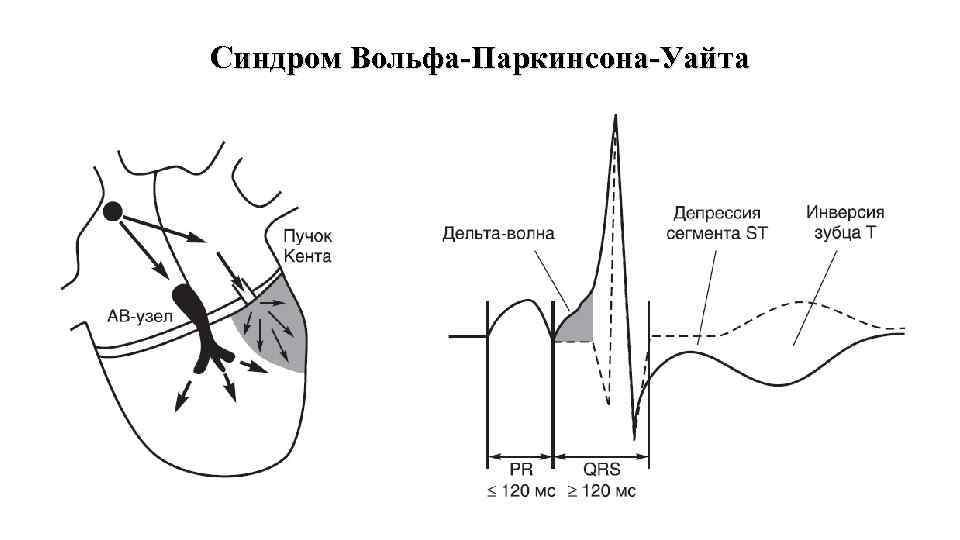 Синдром впв презентация