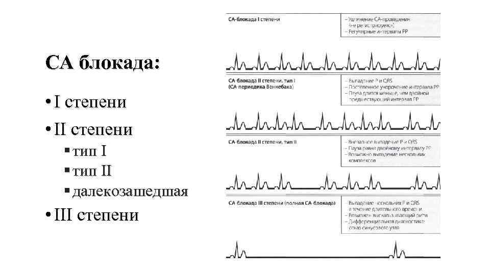 Са блокада сердца