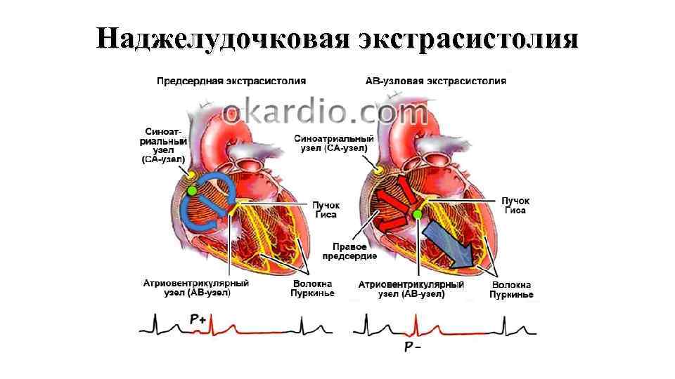 Наджелудочковая экстрасистолия 