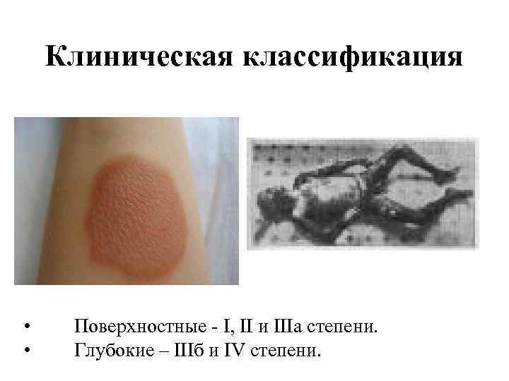Клиническая классификация • • Поверхностные - I, II и IIIa степени. Глубокие – IIIб