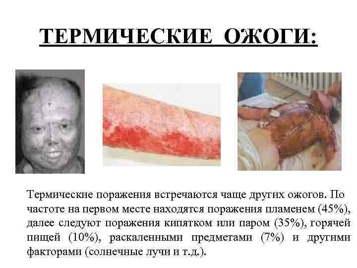 ТЕРМИЧЕСКИЕ ОЖОГИ: Термические поражения встречаются чаще других ожогов. По частоте на первом месте находятся