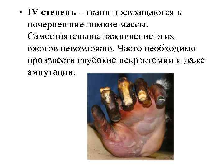  • IV степень – ткани превращаются в почерневшие ломкие массы. Самостоятельное заживление этих