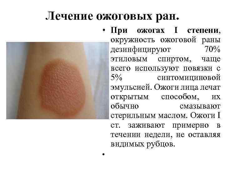 Лечение ожоговых ран. • При ожогах I степени, окружность ожоговой раны дезинфицируют 70% этиловым