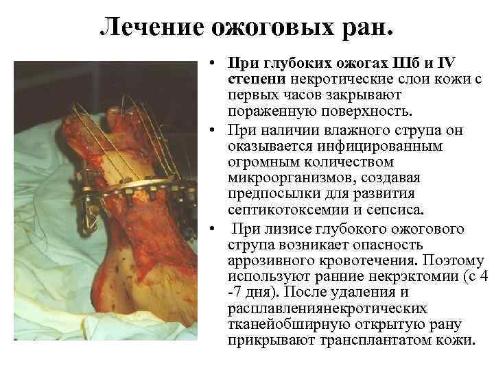 Лечение ожоговых ран. • При глубоких ожогах IIIб и IV степени некротические слои кожи