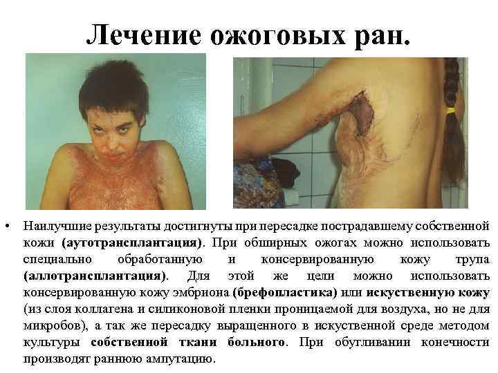 Лечение ожоговых ран. • Наилучшие результаты достигнуты при пересадке пострадавшему собственной кожи (аутотрансплантация). При