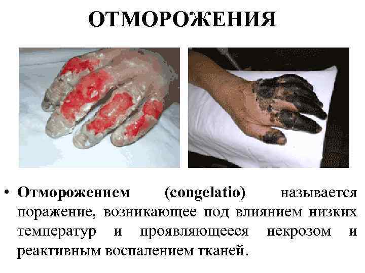 ОТМОРОЖЕНИЯ • Отморожением (congelatio) называется поражение, возникающее под влиянием низких температур и проявляющееся некрозом
