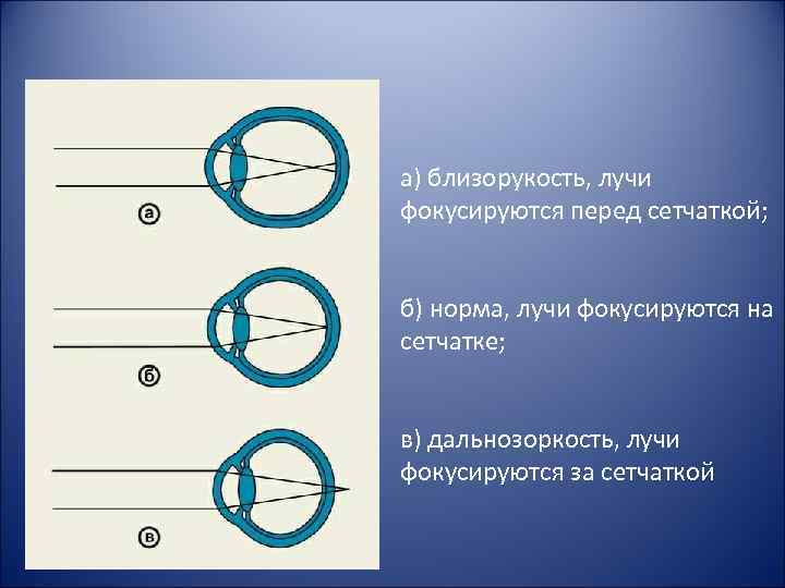 а) близорукость, лучи фокусируются перед сетчаткой; б) норма, лучи фокусируются на сетчатке; в) дальнозоркость,